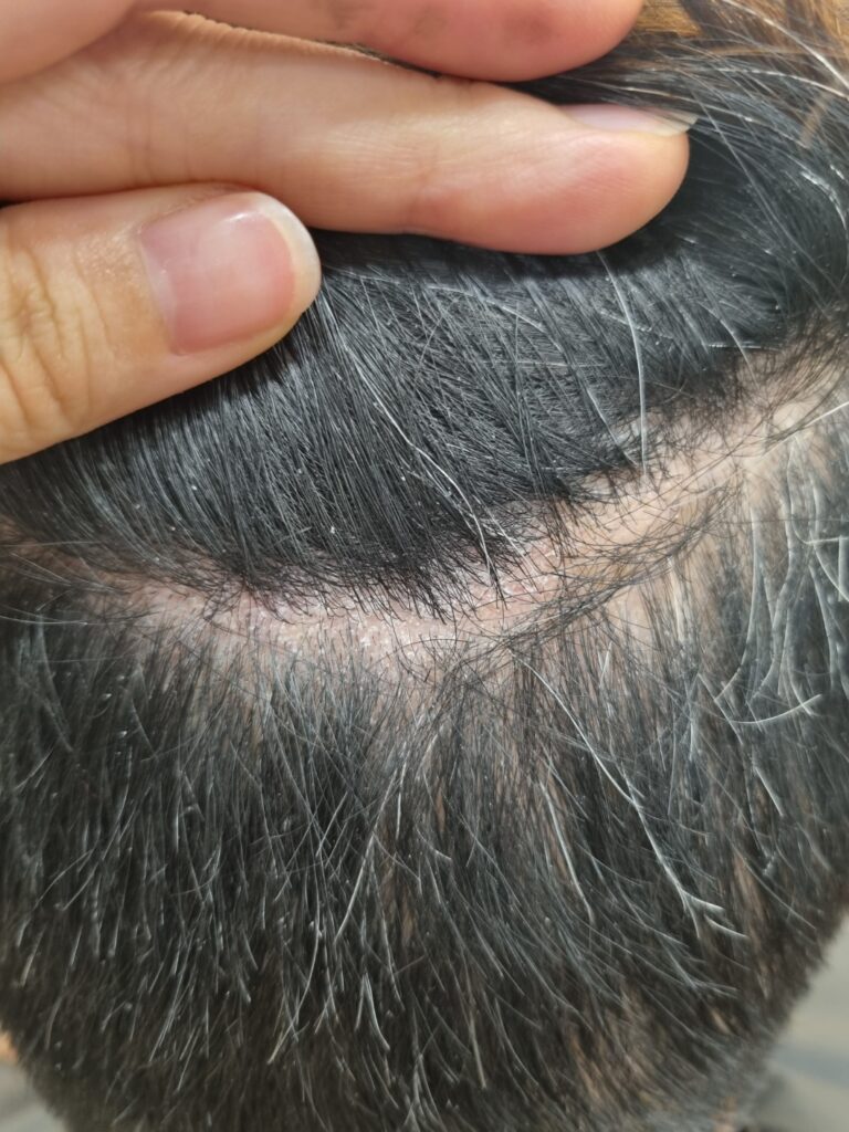 두피 디톡스 전 각질과 피지가 쌓여 있는 두피 상태의 모습