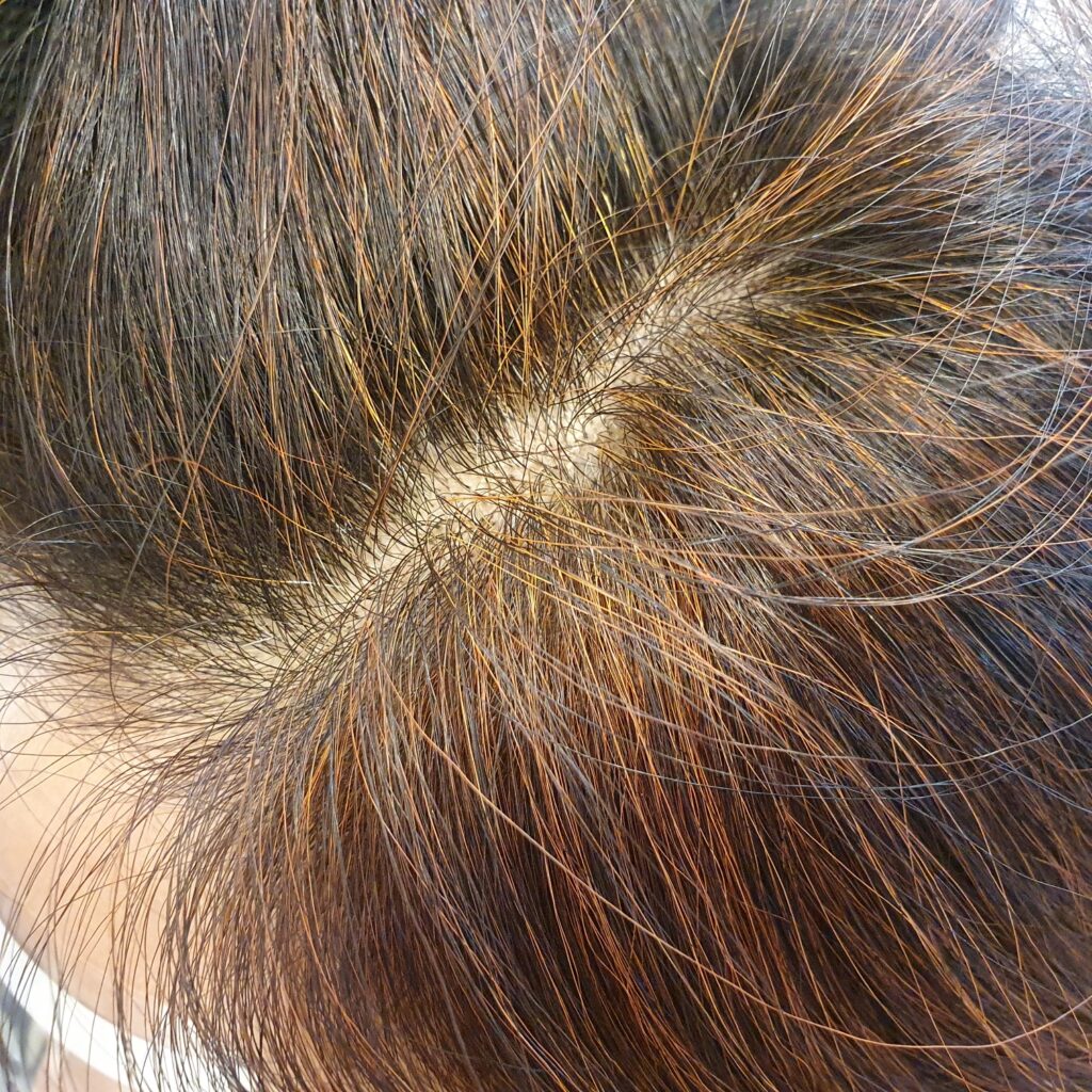 천연허브 염색인 헤나와 인디고 배합으로 자극 없이 완벽하게 새치 커버를 완료한 모발 상태