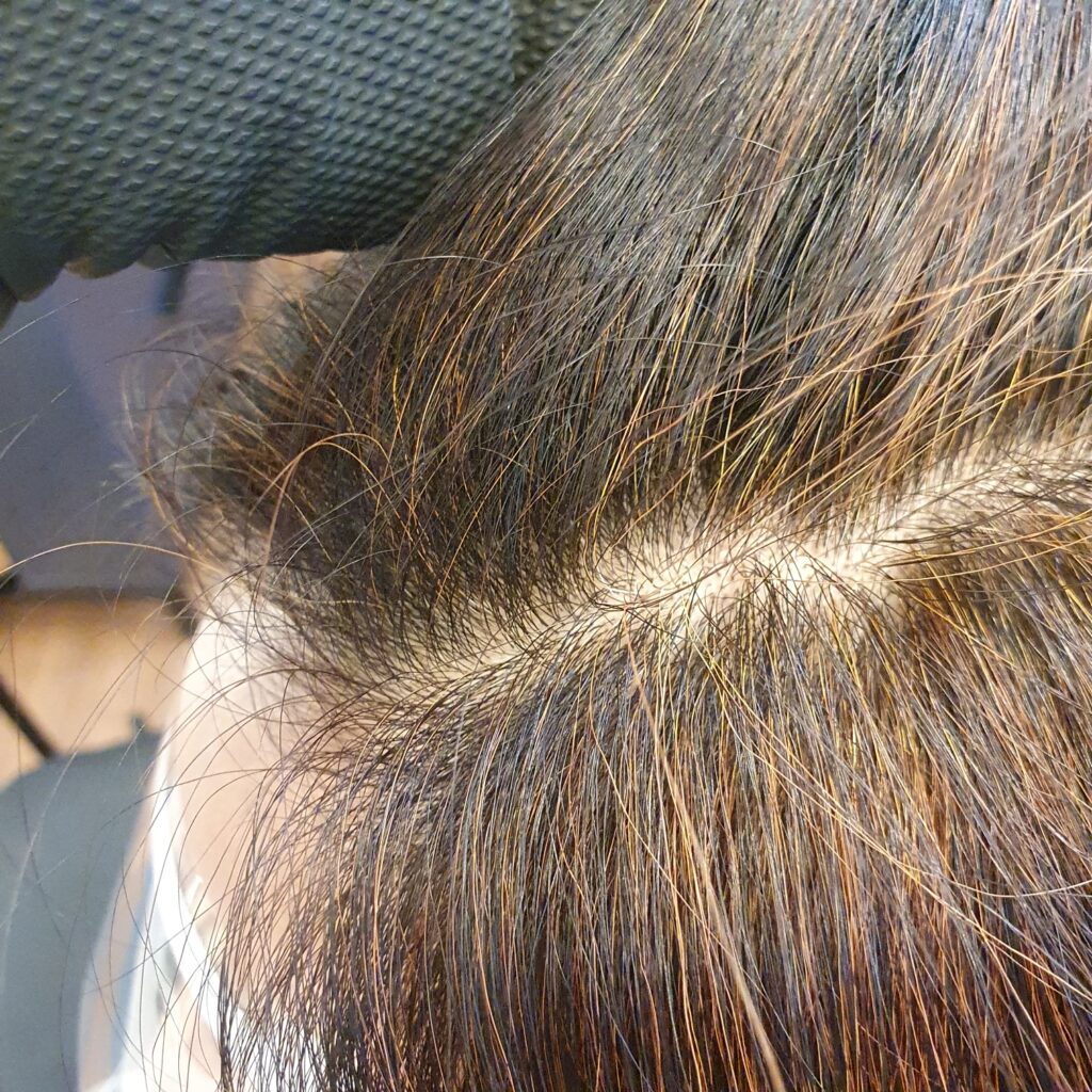 천연 염색 부작용 두피 가려움증 증상